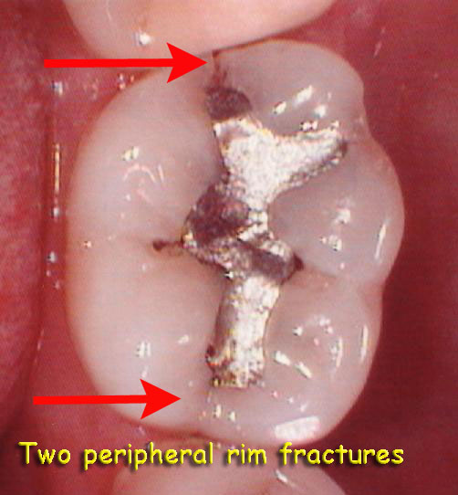 Occlusal effect5.1web2.jpg